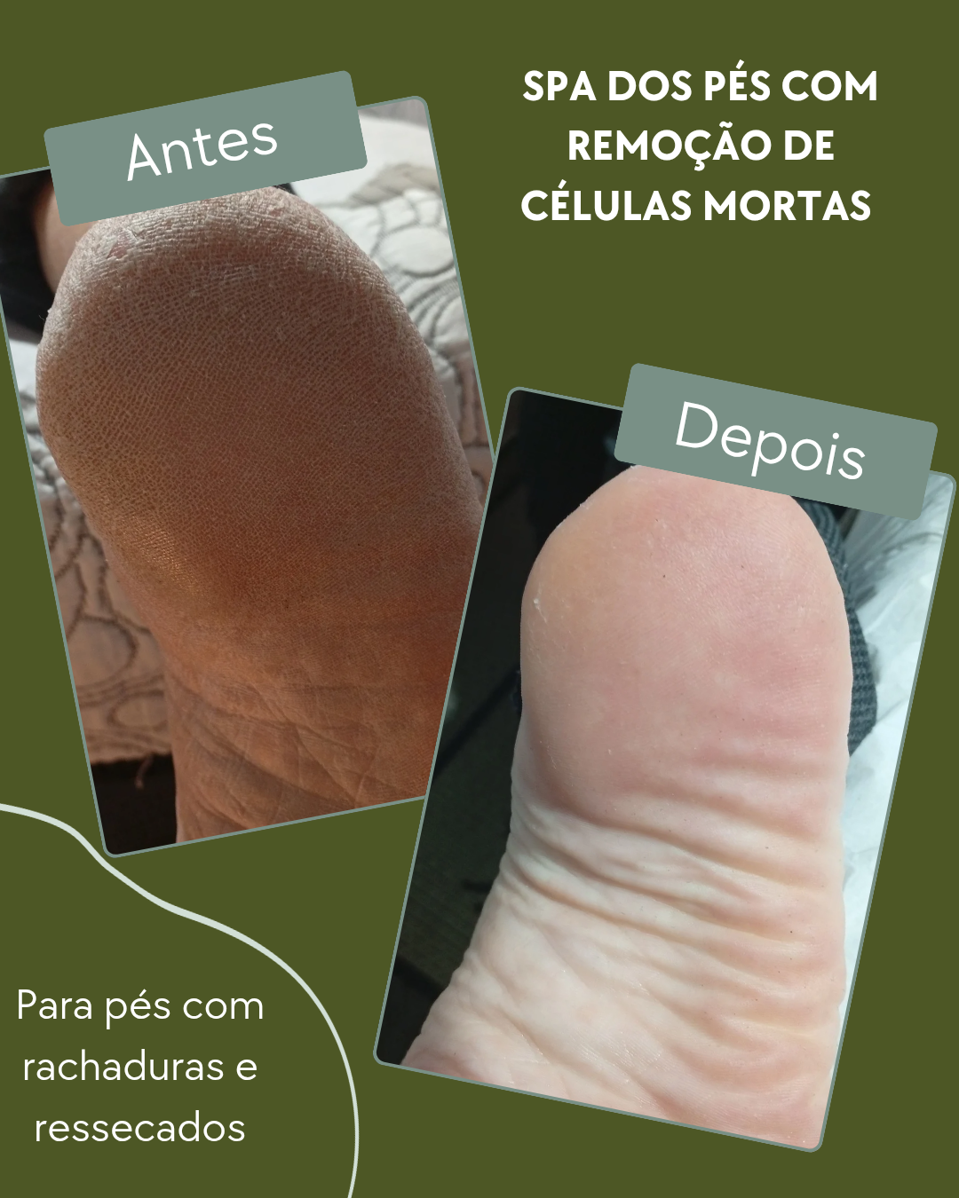 Spa dos pés: remoção de células mortas, rachaduras e ressecamento. Pés lisinhos, hidratados e renovados para você se sentir confortável e confiante!
Que tal ter essa maravilhosa experiência de ficar com pezinhos de fora sem sentir vergonha de aparecer?